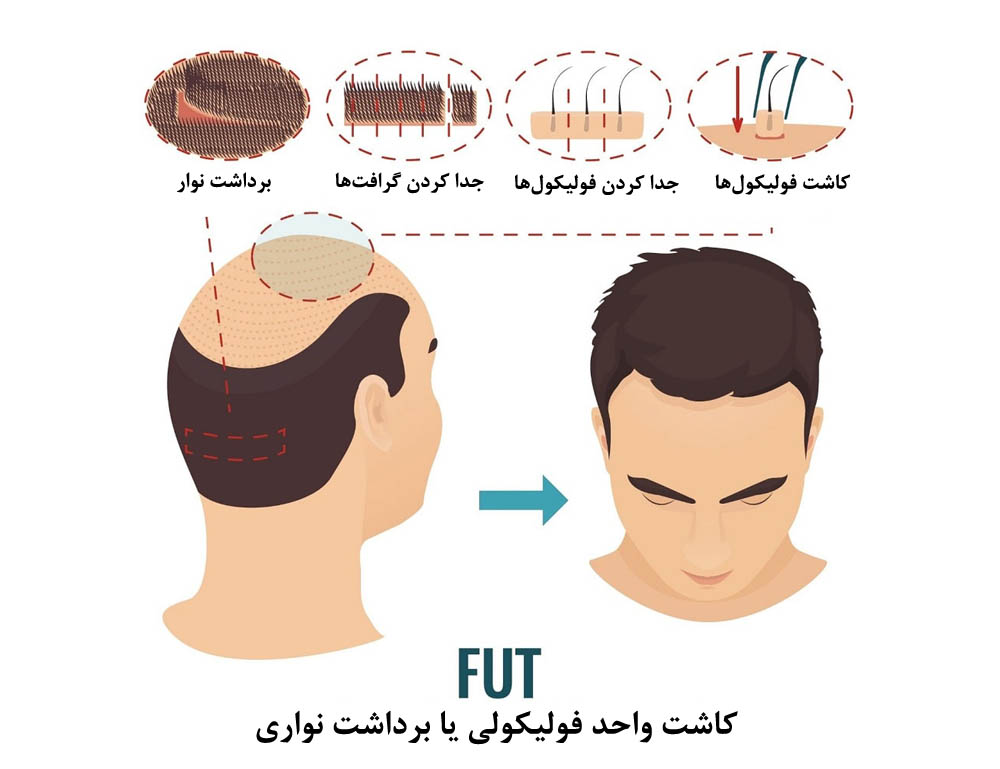 روش کاشت نواری یاFUT